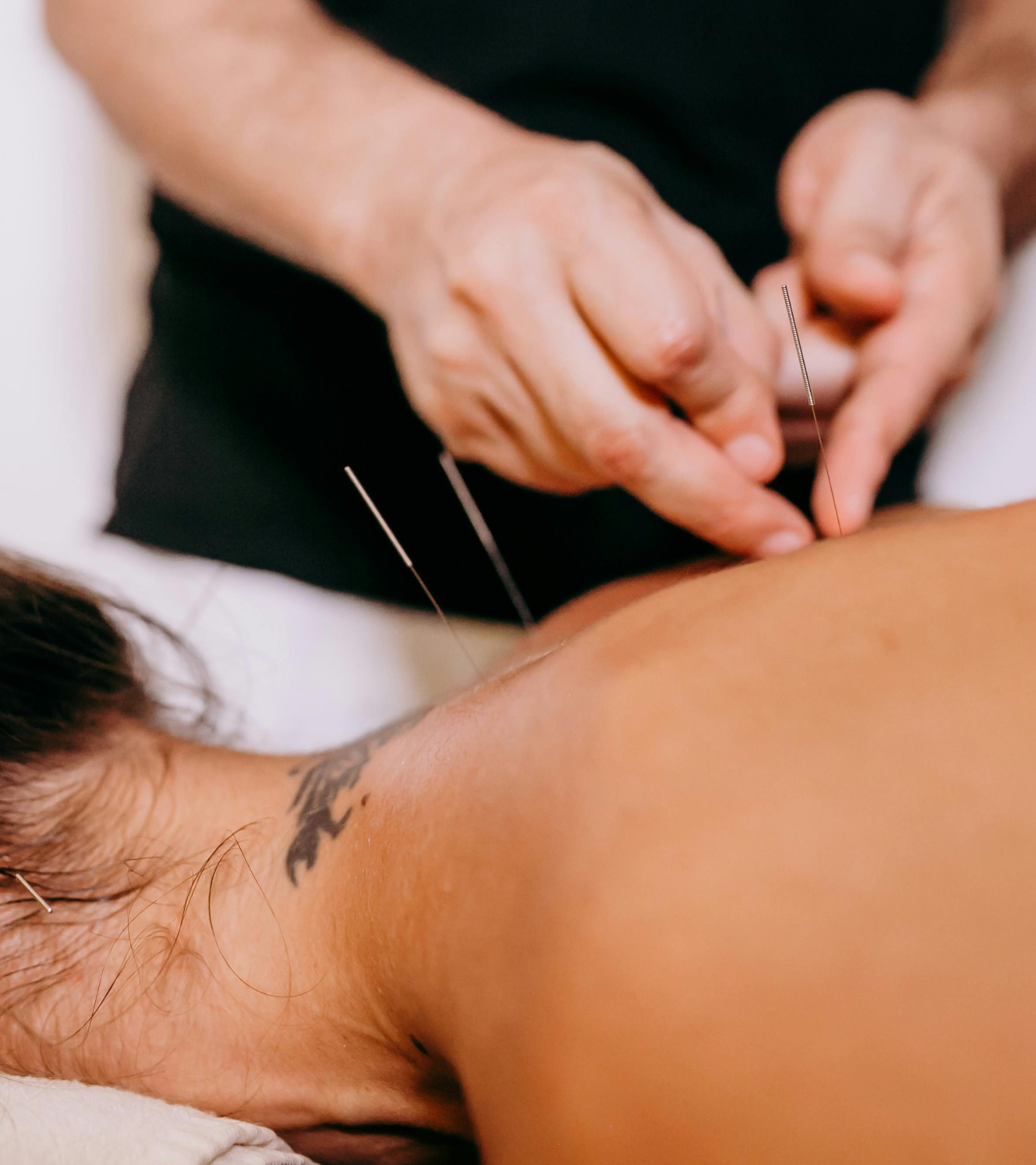 acupuncture back pain neck pain